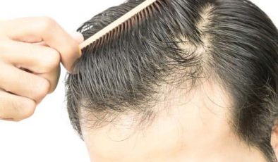 Saç Dökülmesi Tedavisi