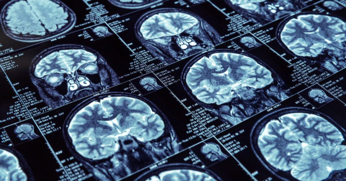 Alzheimer ve demansa karşı beslenme önerileri